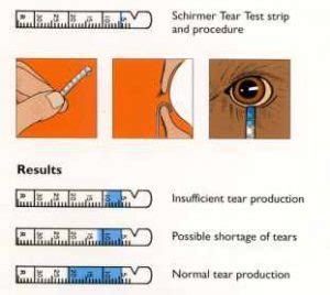 4 tear test|positive schirmer's test.